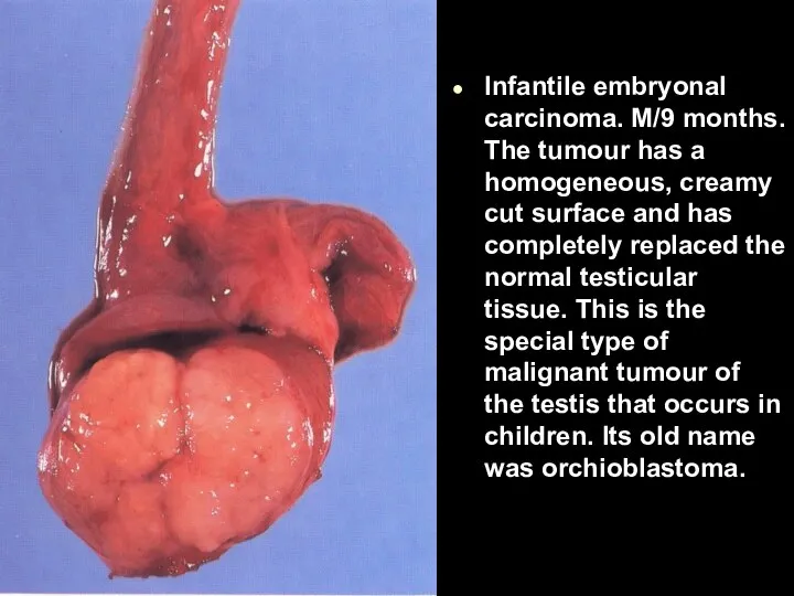 Infantile embryonal carcinoma. M/9 months. The tumour has a homogeneous, creamy cut