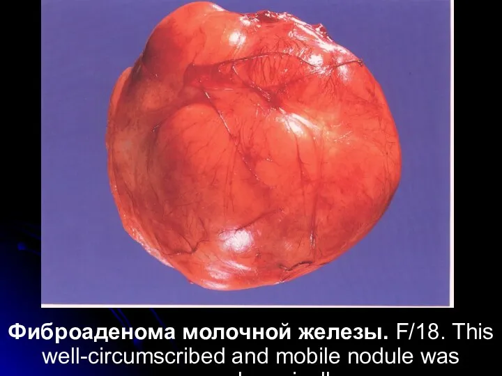 Фиброаденома молочной железы. F/18. This well-circumscribed and mobile nodule was removed surgically.