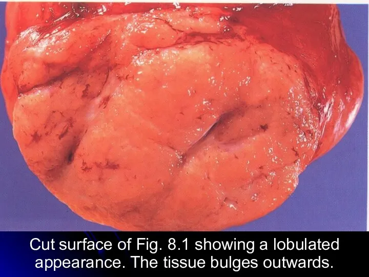 Cut surface of Fig. 8.1 showing a lobulated appearance. The tissue bulges outwards.