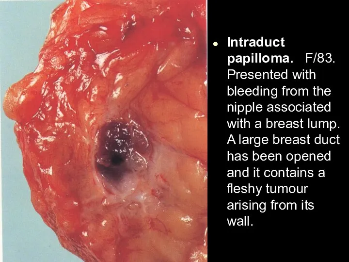 Intraduct papilloma. F/83. Presented with bleeding from the nipple associated with a