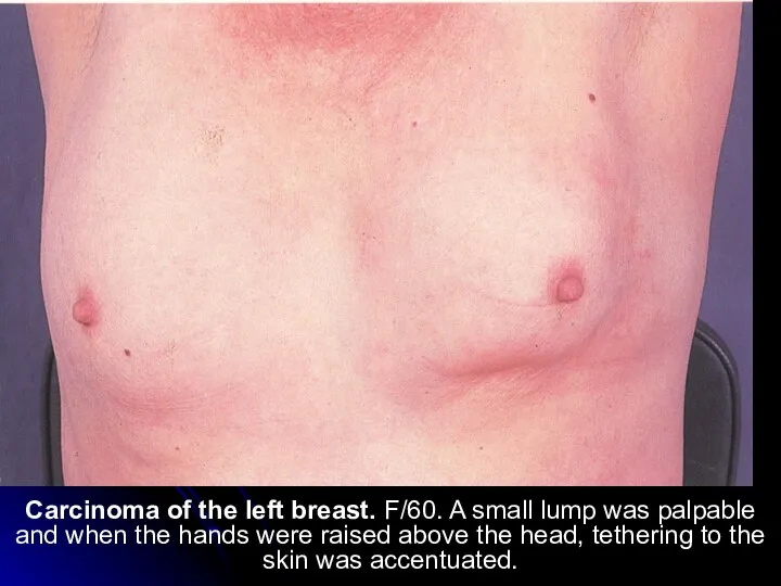 Carcinoma of the left breast. F/60. A small lump was palpable and
