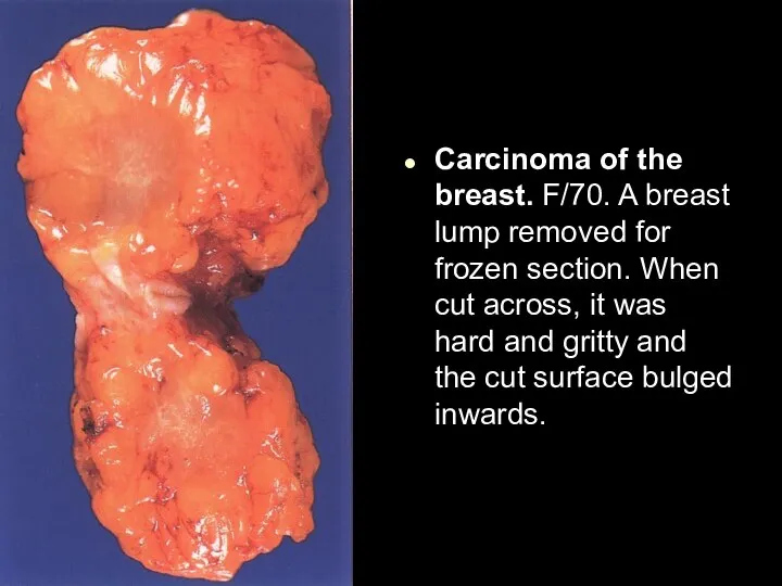 Carcinoma of the breast. F/70. A breast lump removed for frozen section.