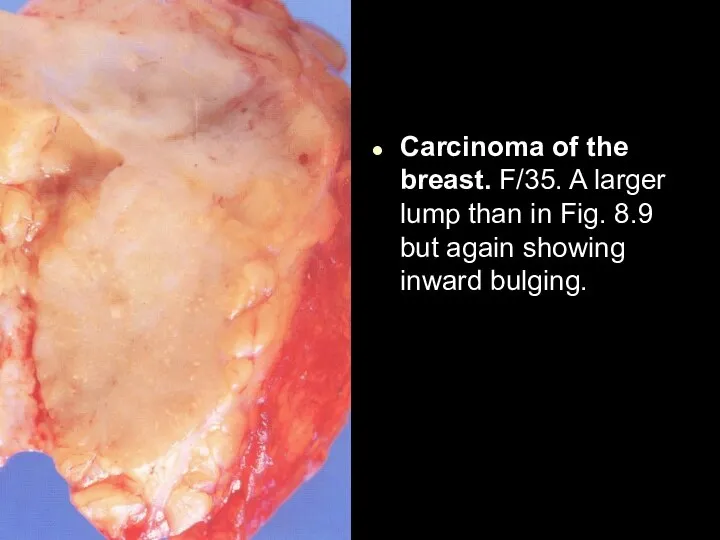 Carcinoma of the breast. F/35. A larger lump than in Fig. 8.9