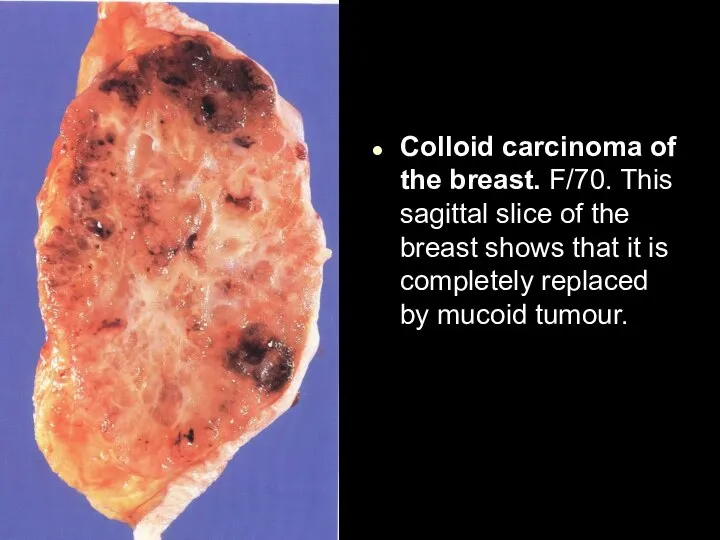 Colloid carcinoma of the breast. F/70. This sagittal slice of the breast