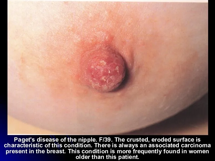 Paget's disease of the nipple. F/39. The crusted, eroded surface is characteristic