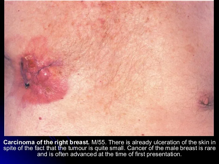 Carcinoma of the right breast. M/55. There is already ulceration of the