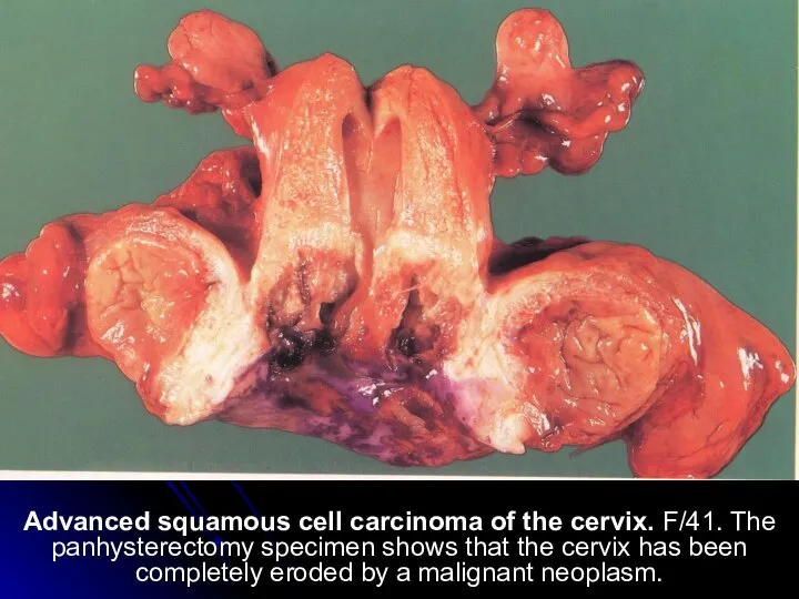 Advanced squamous cell carcinoma of the cervix. F/41. The panhysterectomy specimen shows