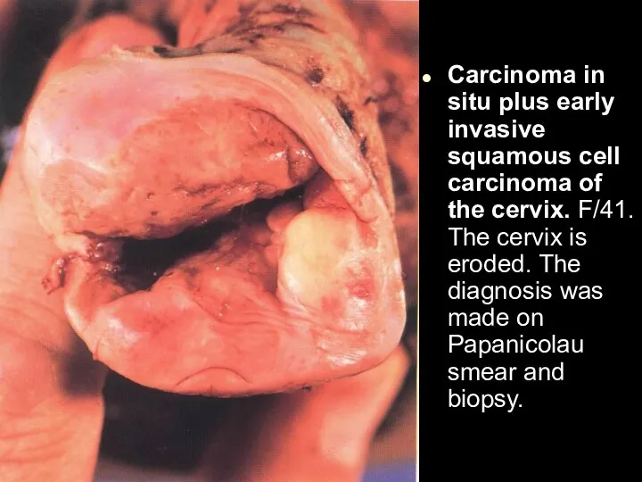 Carcinoma in situ plus early invasive squamous cell carcinoma of the cervix.