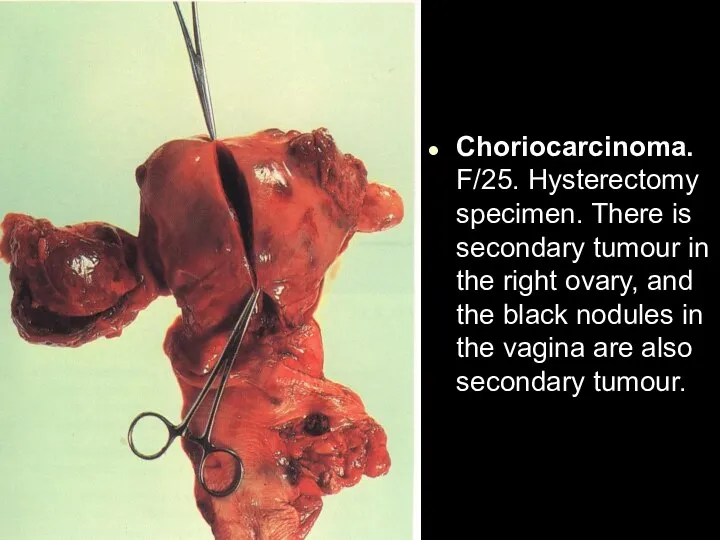 Choriocarcinoma. F/25. Hysterectomy specimen. There is secondary tumour in the right ovary,