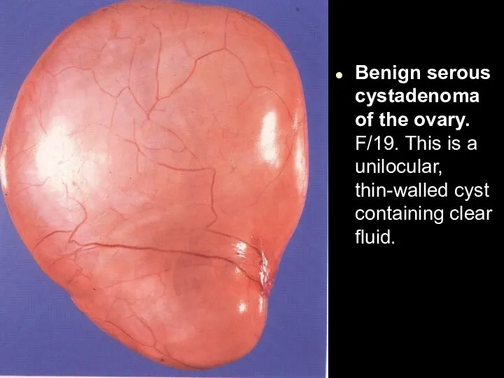 Benign serous cystadenoma of the ovary. F/19. This is a unilocular, thin-walled cyst containing clear fluid.