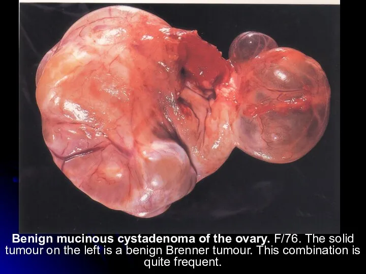 Benign mucinous cystadenoma of the ovary. F/76. The solid tumour on the