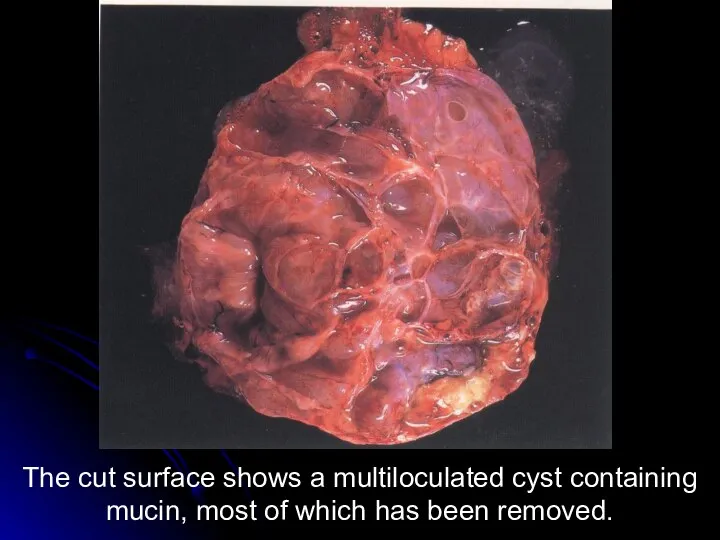 The cut surface shows a multiloculated cyst containing mucin, most of which has been removed.