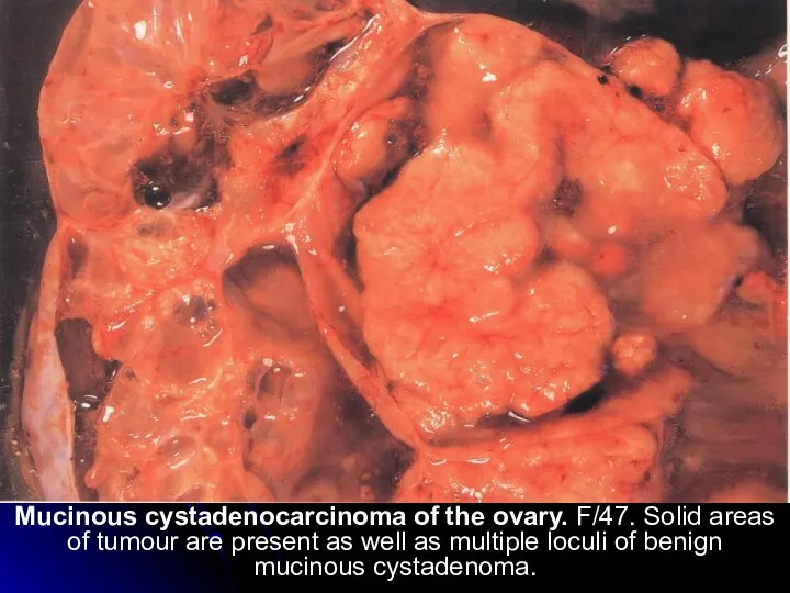 Mucinous cystadenocarcinoma of the ovary. F/47. Solid areas of tumour are present