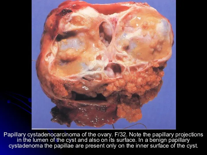 Papillary cystadenocarcinoma of the ovary. F/32. Note the papillary projections in the