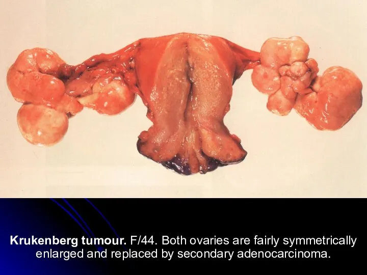 Krukenberg tumour. F/44. Both ovaries are fairly symmetrically enlarged and replaced by secondary adenocarcinoma.