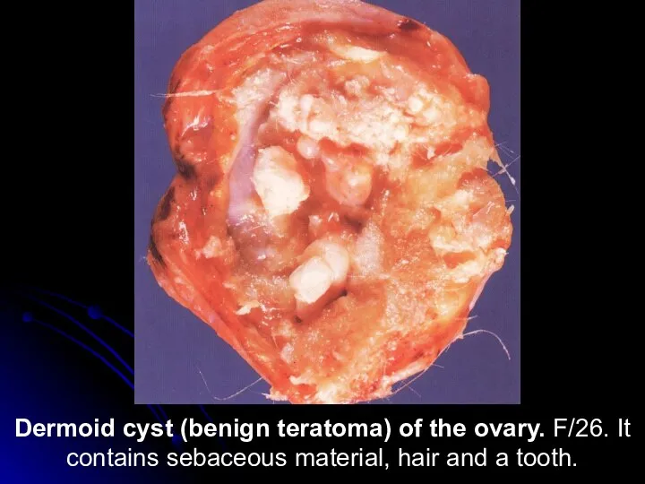 Dermoid cyst (benign teratoma) of the ovary. F/26. It contains sebaceous material, hair and a tooth.