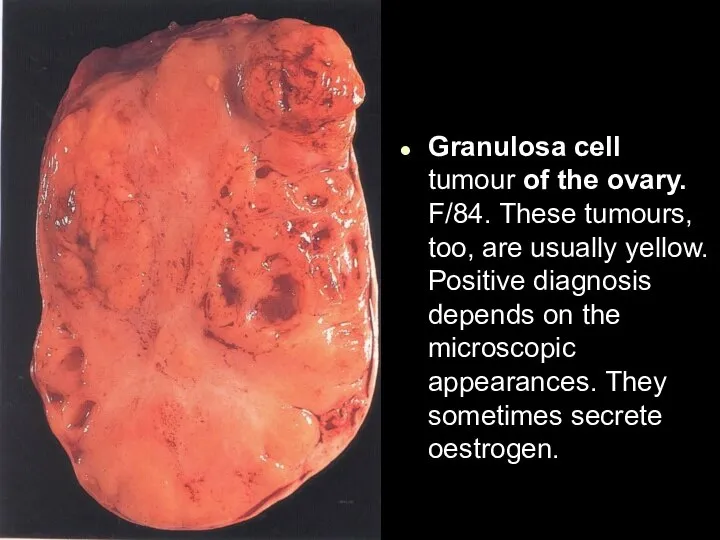 Granulosa cell tumour of the ovary. F/84. These tumours, too, are usually