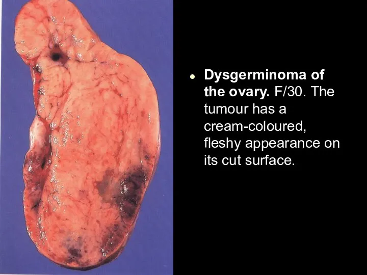 Dysgerminoma of the ovary. F/30. The tumour has a cream-coloured, fleshy appearance on its cut surface.