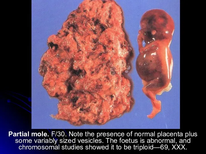 Partial mole. F/30. Note the presence of normal placenta plus some variably