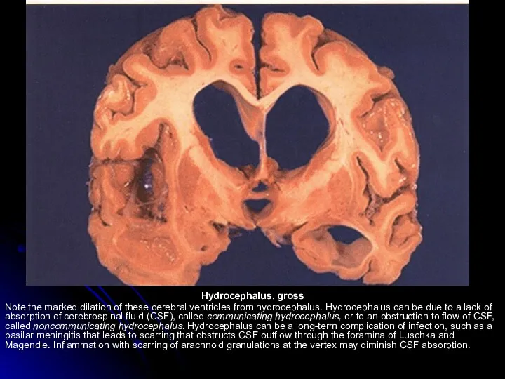 Hydrocephalus, gross Note the marked dilation of these cerebral ventricles from hydrocephalus.