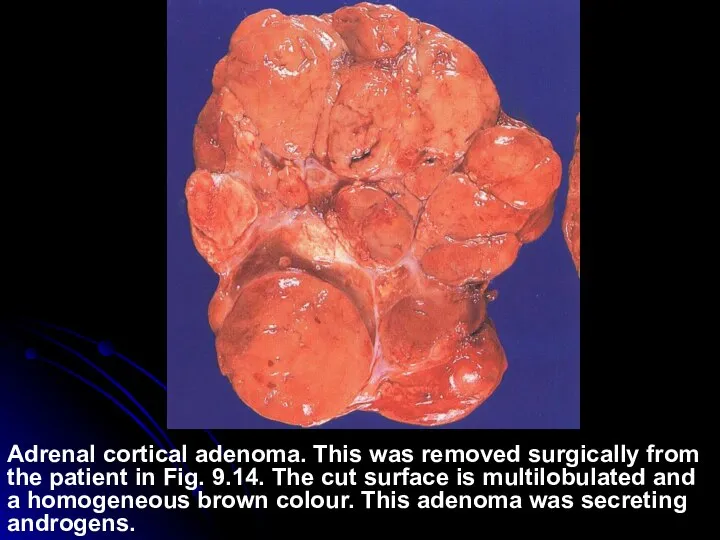 Adrenal cortical adenoma. This was removed surgically from the patient in Fig.