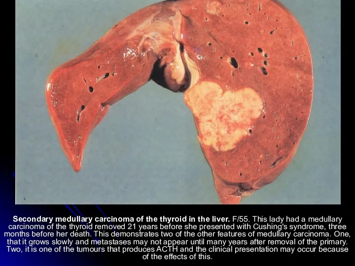 Secondary medullary carcinoma of the thyroid in the liver. F/55. This lady