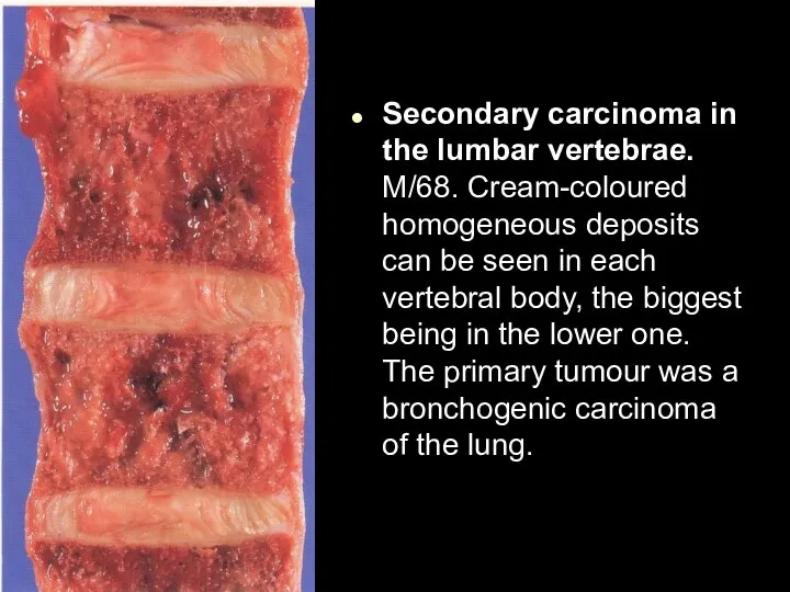 Secondary carcinoma in the lumbar vertebrae. M/68. Cream-coloured homogeneous deposits can be