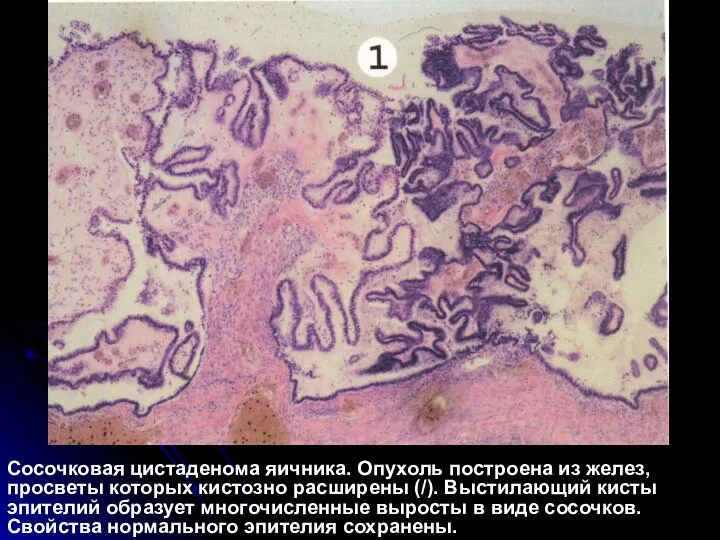 Сосочковая цистаденома яичника. Опухоль построена из желез, просветы которых кистозно расширены (/).