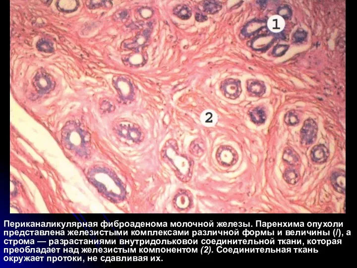 Периканаликулярная фиброаденома молочной железы. Паренхима опухоли представлена железистыми комплексами различной формы и
