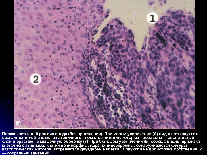 Плоскоклеточный рак пищевода (без ороговения). При малом увеличении (А) видно, что опухоль