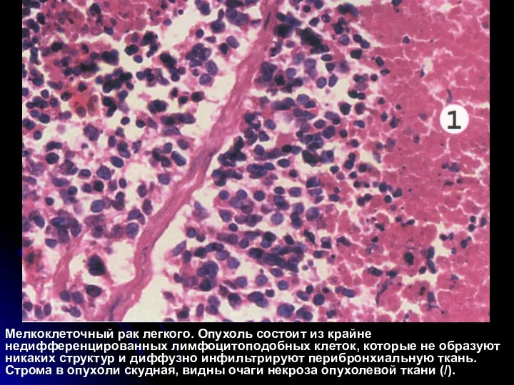 Мелкоклеточный рак легкого. Опухоль состоит из крайне недифференцированных лимфоцитоподобных клеток, которые не
