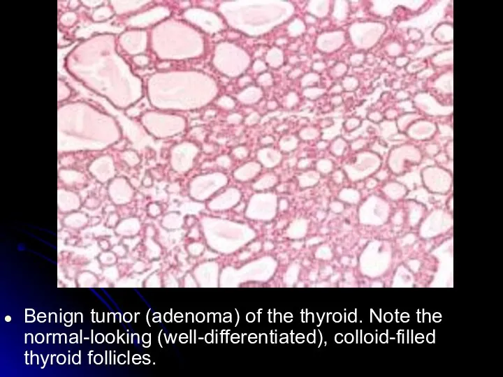 Benign tumor (adenoma) of the thyroid. Note the normal-looking (well-differentiated), colloid-filled thyroid follicles.