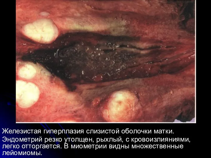 Железистая гиперплазия слизистой оболочки матки. Эндометрий резко утолщен, рыхлый, с кровоизлияниями, легко