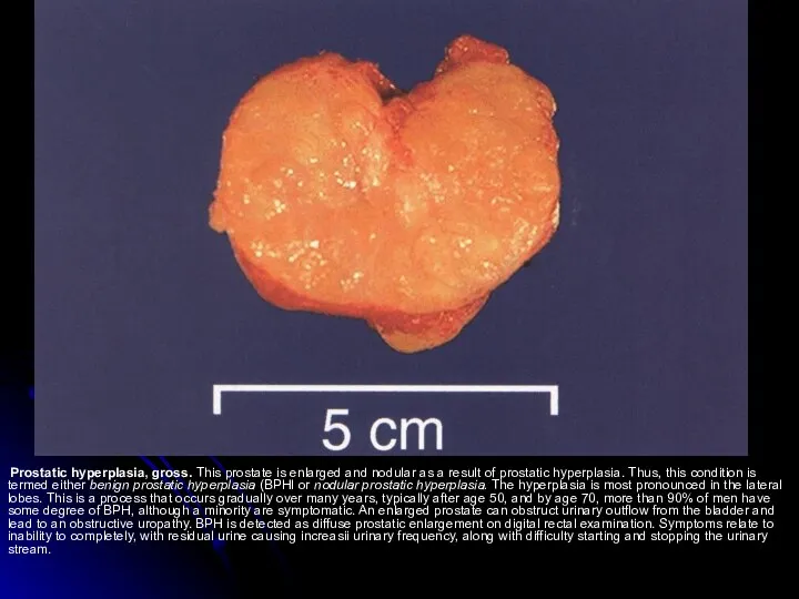 Prostatic hyperplasia, gross. This prostate is enlarged and nodular as a result