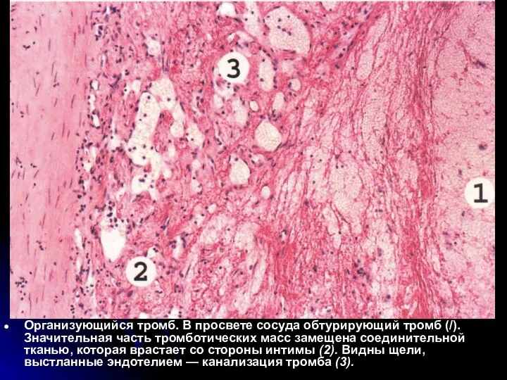 Организующийся тромб. В просвете сосуда обтурирующий тромб (/). Значительная часть тромботических масс