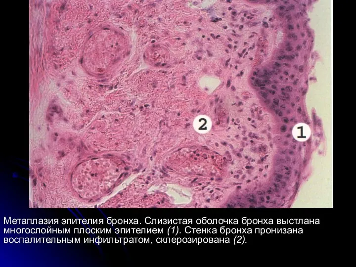 Метаплазия эпителия бронха. Слизистая оболочка бронха выстлана многослойным плоским эпителием (1). Стенка