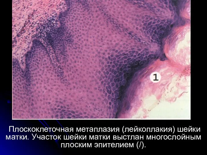 Плоскоклеточная метаплазия (лейкоплакия) шейки матки. Участок шейки матки выстлан многослойным плоским эпителием (/).