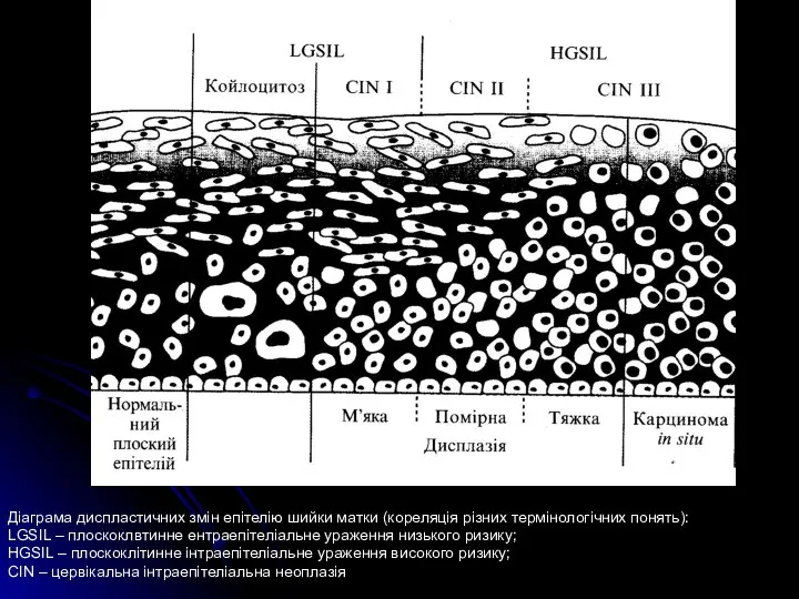 Діаграма диспластичних змін епітелію шийки матки (кореляція різних термінологічних понять): LGSIL –