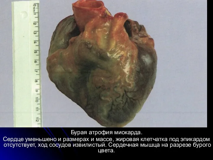 Бурая атрофия миокарда. Сердце уменьшено и размерах и массе, жировая клетчатка под