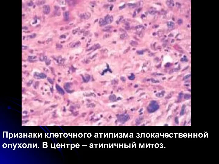 Признаки клеточного атипизма злокачественной опухоли. В центре – атипичный митоз.