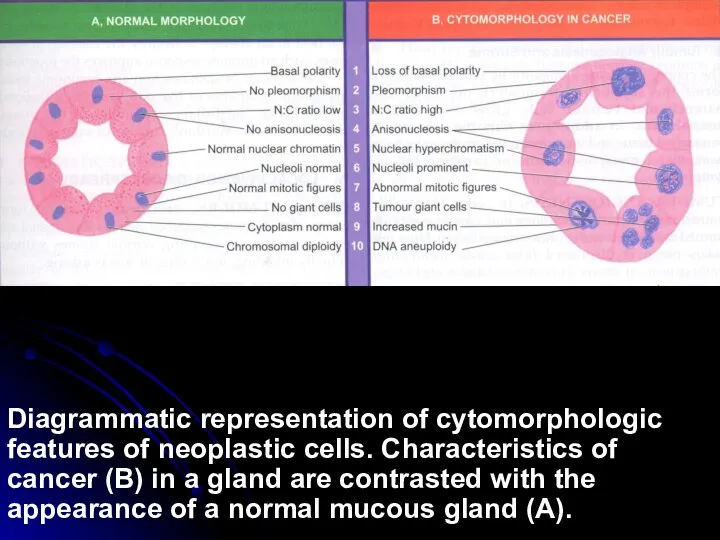 Diagrammatic representation of cytomorphologic features of neoplastic cells. Characteristics of cancer (B)