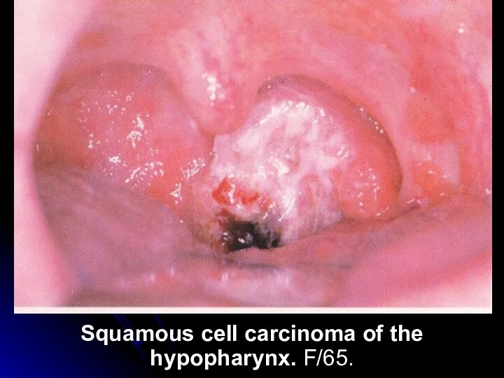 Squamous cell carcinoma of the hypopharynx. F/65.