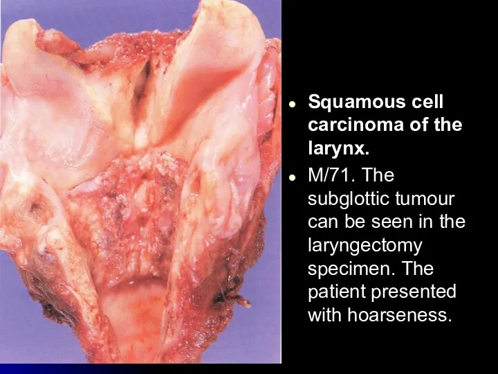 Squamous cell carcinoma of the larynx. M/71. The subglottic tumour can be