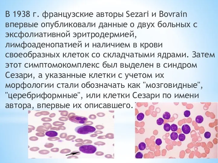 В 1938 г. французские авторы Sezari и Bovrain впервые опубликовали данные о