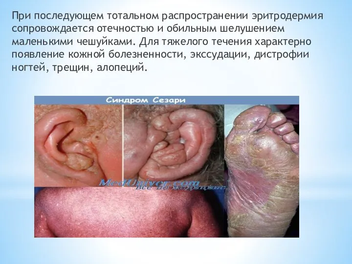 При последующем тотальном распространении эритродермия сопровождается отечностью и обильным шелушением маленькими чешуйками.