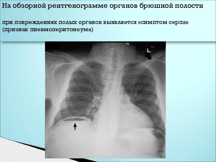 На обзорной рентгенограмме органов брюшной полости при повреждениях полых органов выявляется «симптом серпа» (признак пневмоперитонеума)