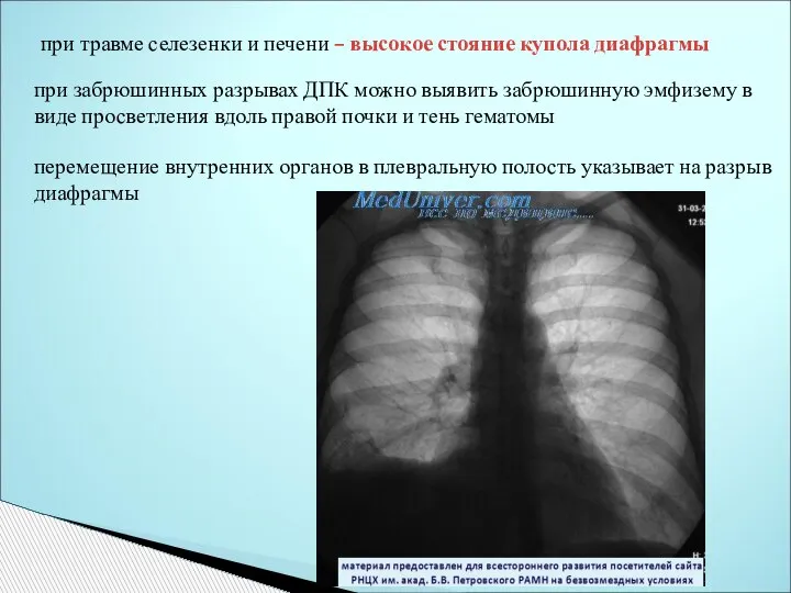 при травме селезенки и печени – высокое стояние купола диафрагмы при забрюшинных