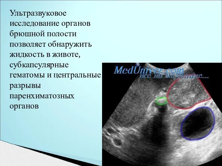 Ультразвуковое исследование органов брюшной полости позволяет обнаружить жидкость в животе, субкапсулярные гематомы