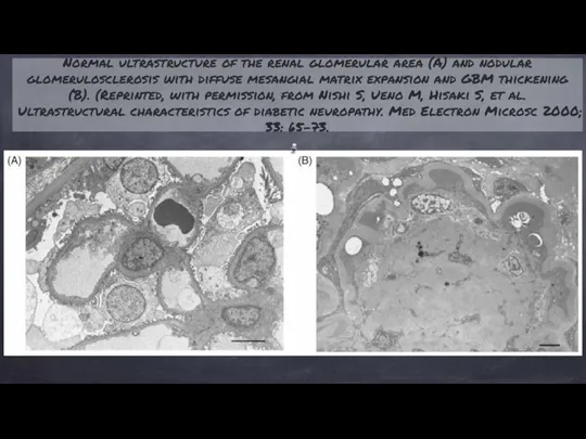 Normal ultrastructure of the renal glomerular area (A) and nodular glomerulosclerosis with