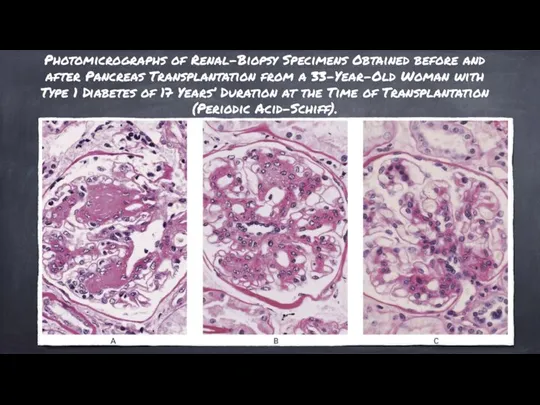 Photomicrographs of Renal-Biopsy Specimens Obtained before and after Pancreas Transplantation from a